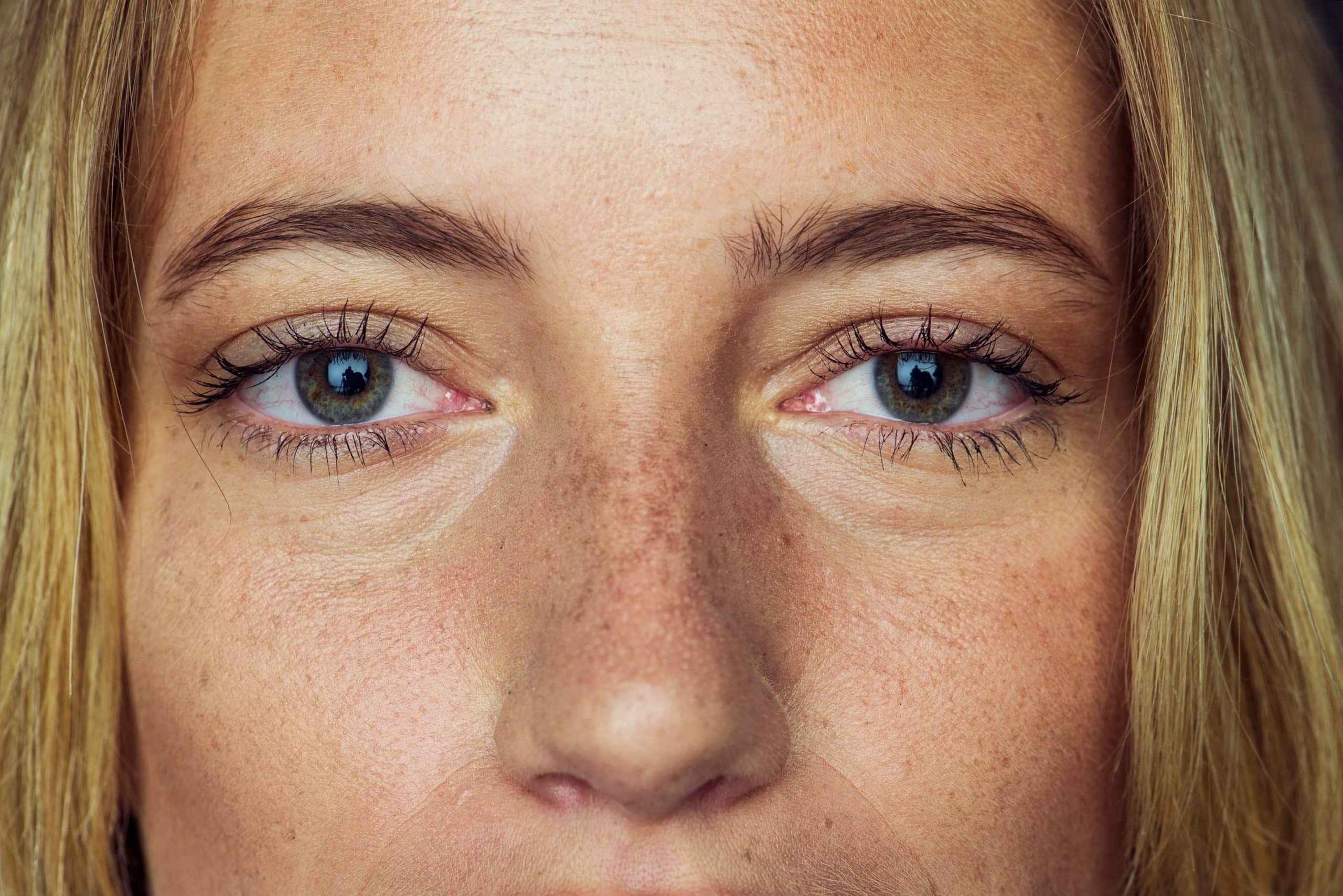 image_skincare_przebarwienia